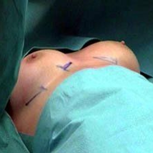 Artsen niet vervolgd voor dood bij liposuctie